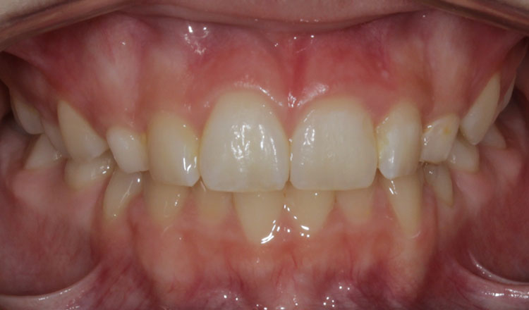 Combo TX orthodontic treatment after - patient 4