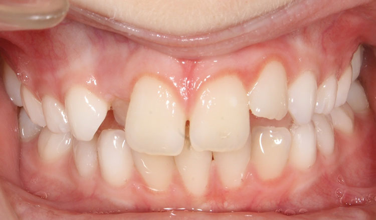 Crossbite orthodontic treatment after - patient 4