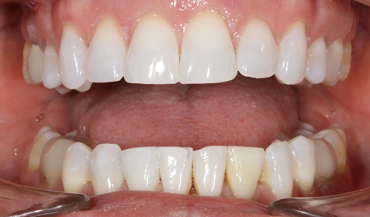 Crowding orthodontic treatment after - patient 4