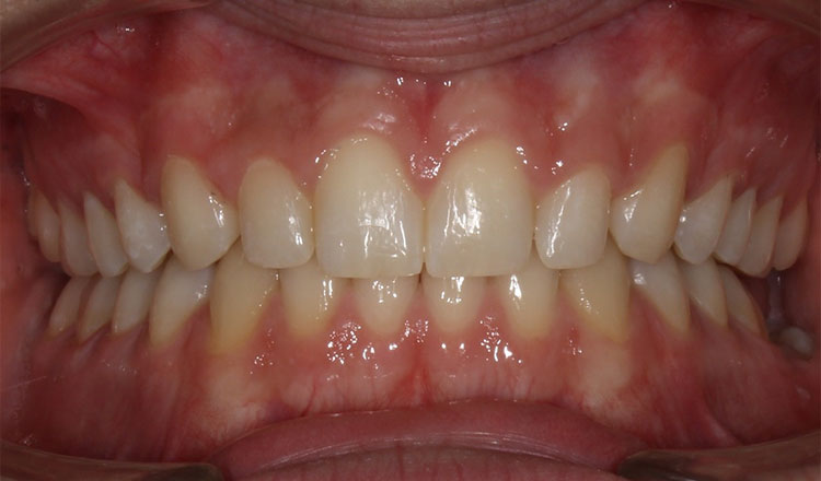 Deepbite orthodontic treatment after - patient 4