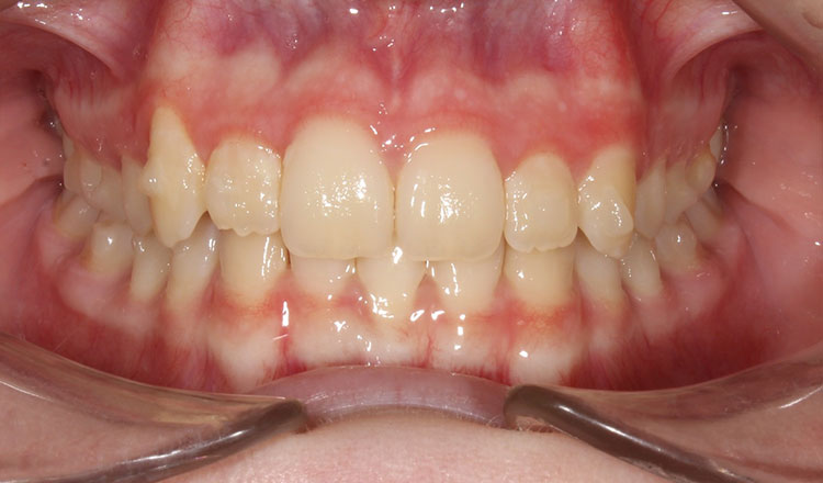 High Canines orthodontic treatment after - patient 4