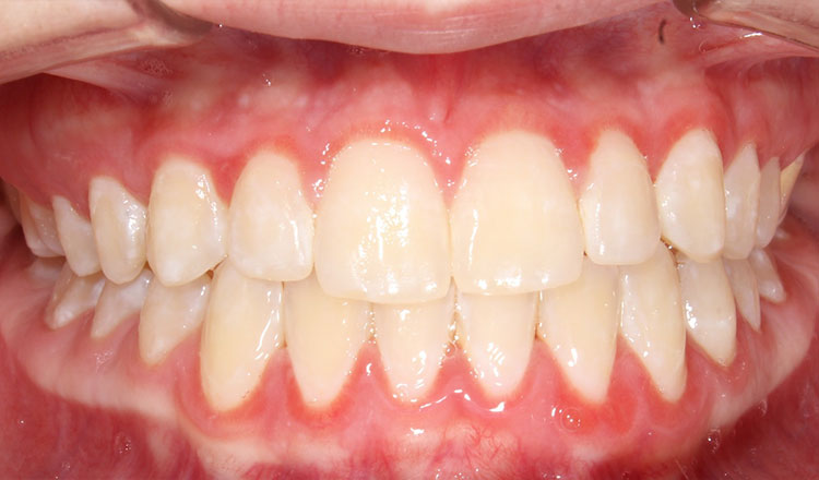 Impacted Canines orthodontic treatment after - patient 4