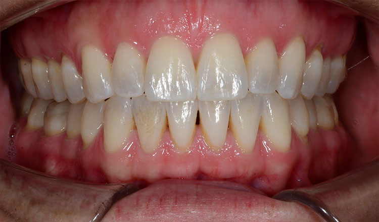 Open Bite orthodontic treatment after - patient 4