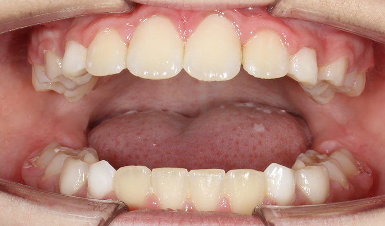 Phase I orthodontic treatment after - patient 4