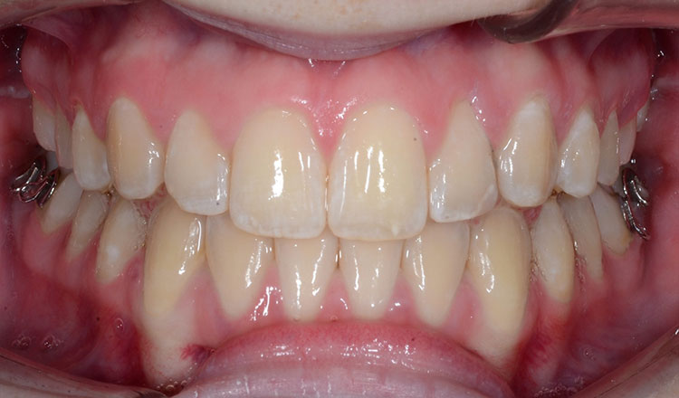 Class II orthodontic treatment after - patient 4