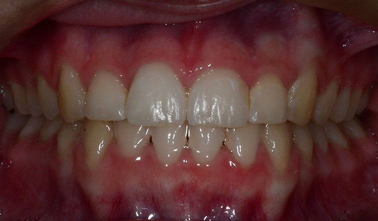 Combo TX orthodontic treatment before - patient 4