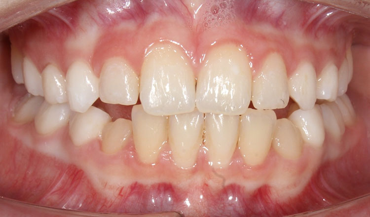 Crossbite orthodontic treatment before - patient 4