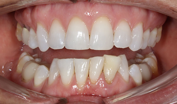 Crowding orthodontic treatment before - patient 4