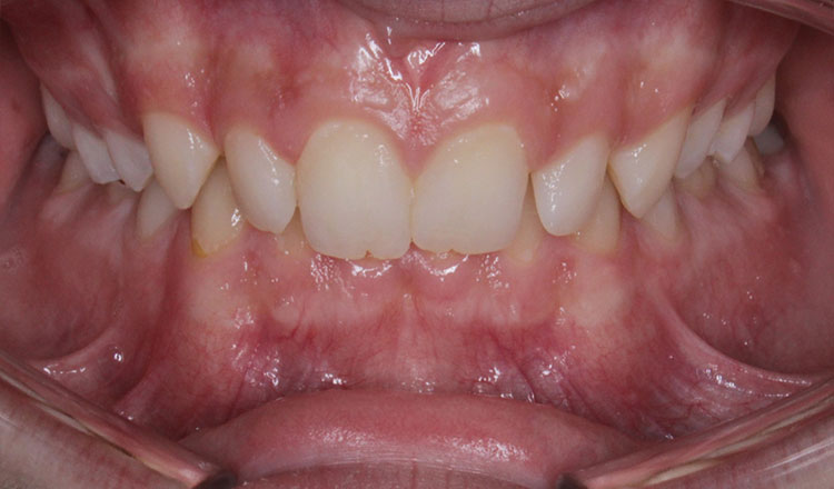 Deepbite orthodontic treatment before - patient 4