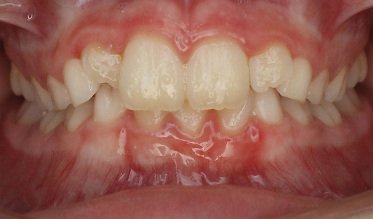 High Canines orthodontic treatment before - patient 4