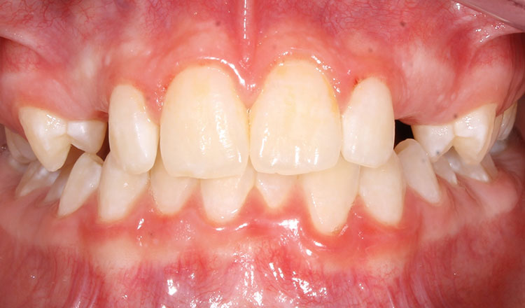 Impacted Canines orthodontic treatment before - patient 4