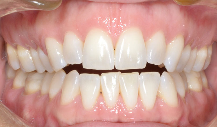 Open Bite orthodontic treatment before - patient 4