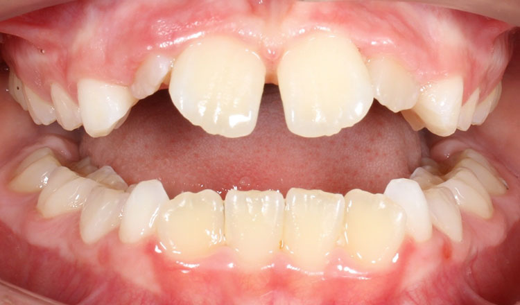 Phase I orthodontic treatment before - patient 4