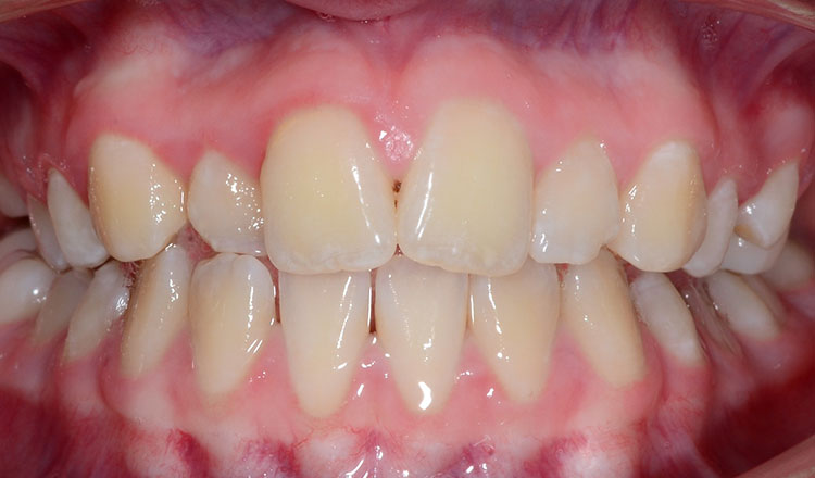 Class II orthodontic treatment before - patient 4