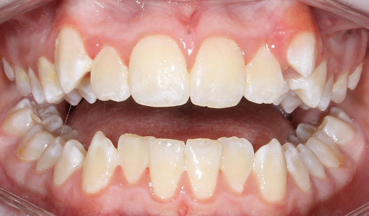Combo TX orthodontic treatment after - patient 5