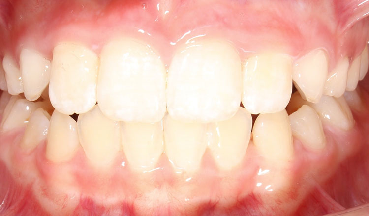 Crossbite orthodontic treatment after - patient 5