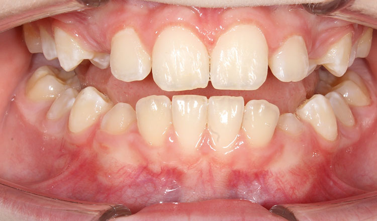 Crowding orthodontic treatment after - patient 5