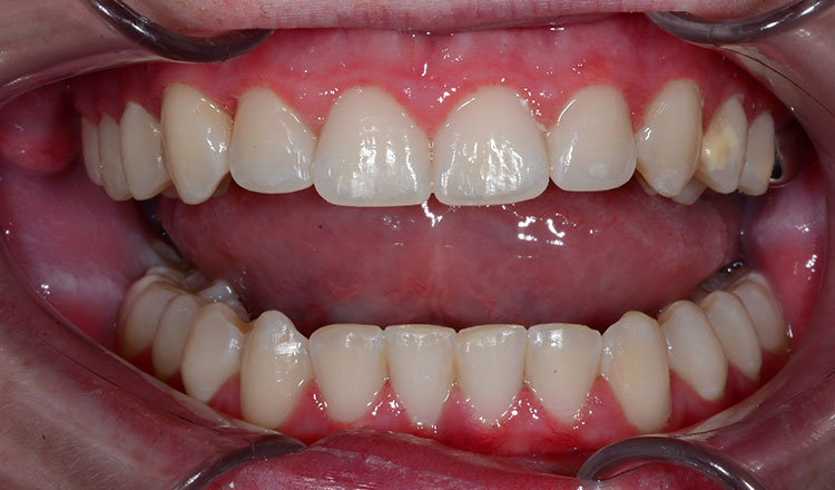 High Canines orthodontic treatment after - patient 5