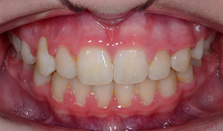Impacted Canines orthodontic treatment after - patient 5