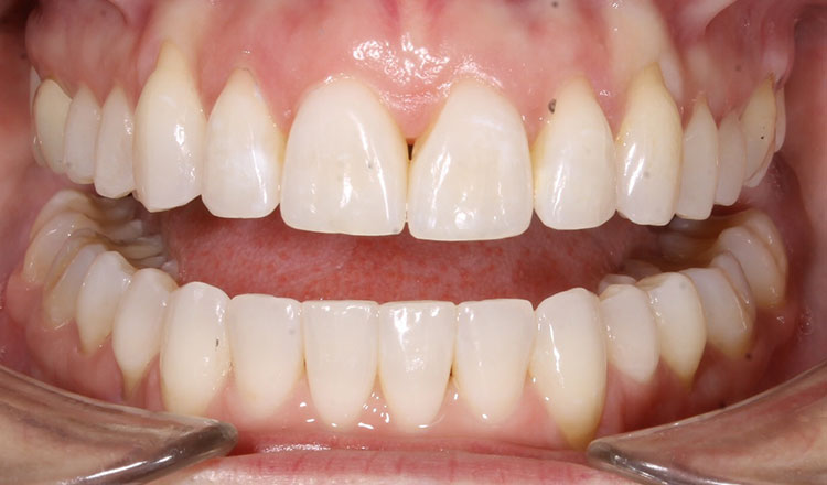 Open Bite orthodontic treatment after - patient 5