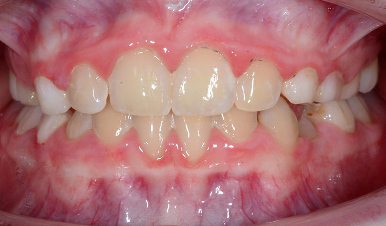 Phase I orthodontic treatment after - patient 5