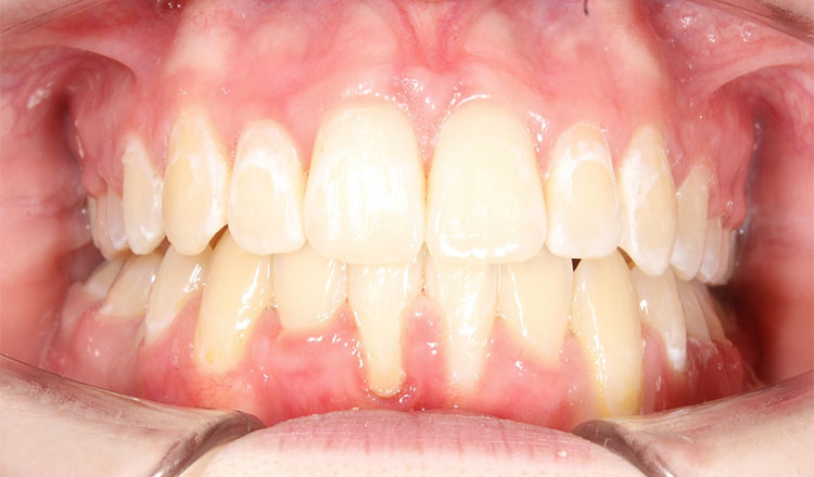 Class II orthodontic treatment after - patient 5