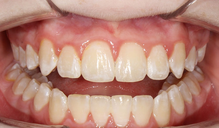 Combo TX orthodontic treatment before - patient 5