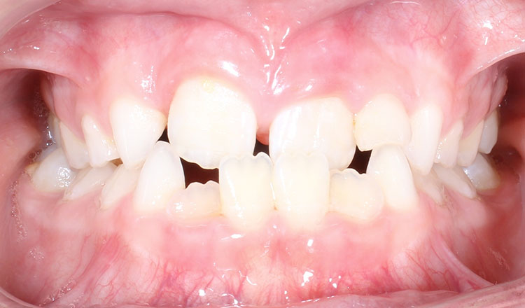 Crossbite orthodontic treatment before - patient 5