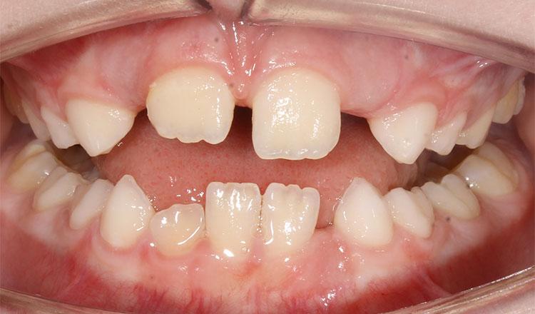Crowding orthodontic treatment before - patient 5