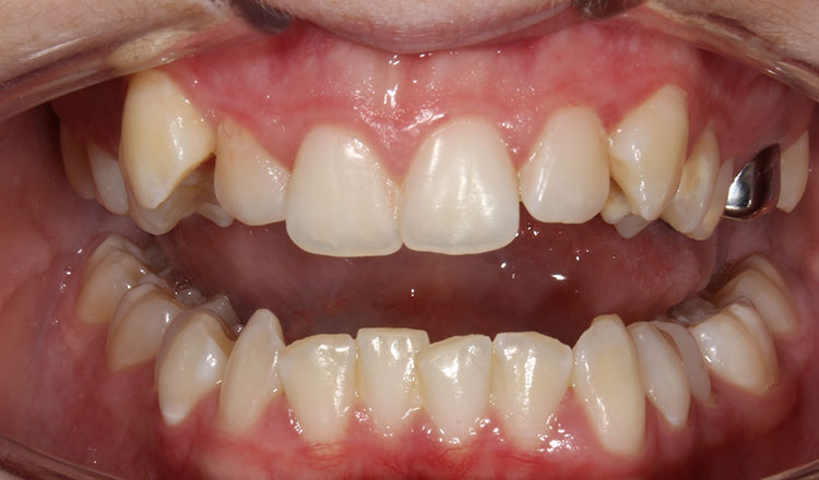 High Canines orthodontic treatment before - patient 5