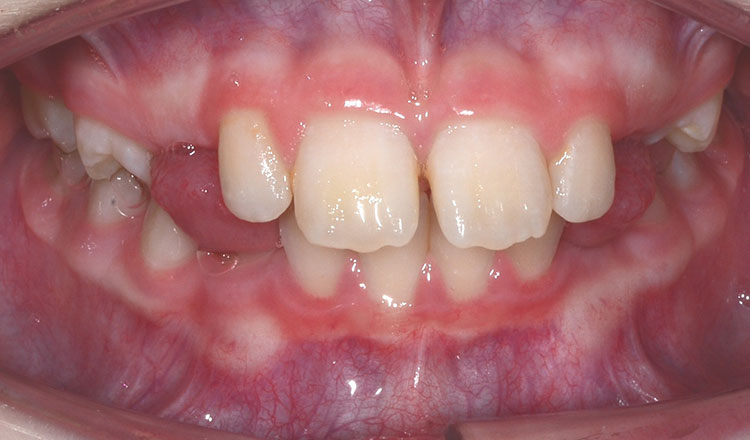 Impacted Canines orthodontic treatment before - patient 5