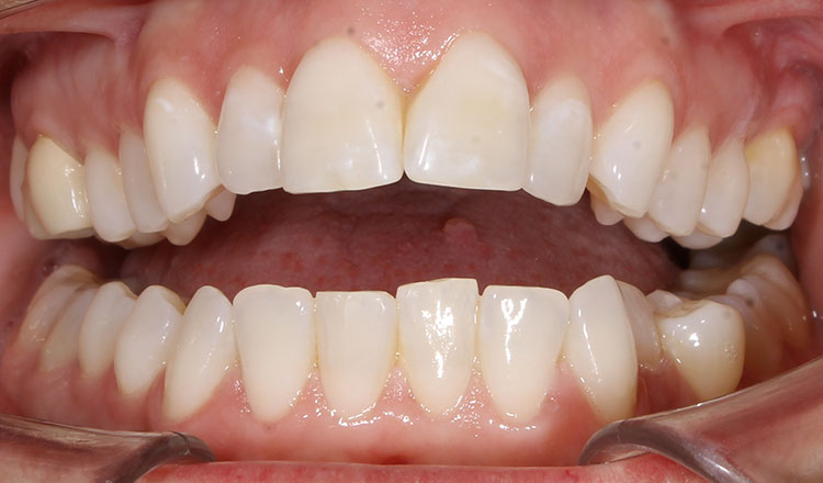 Open Bite orthodontic treatment before - patient 5