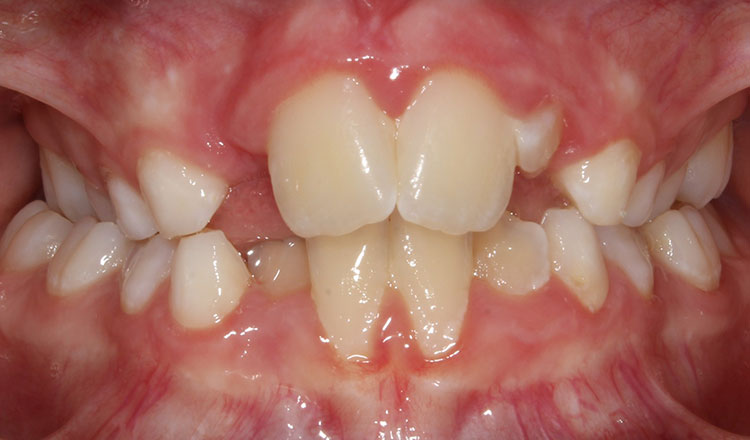 Phase I orthodontic treatment before - patient 5
