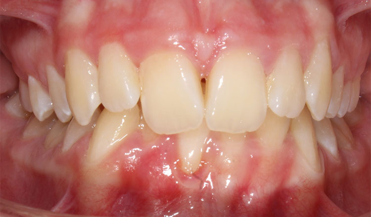 Class II orthodontic treatment before - patient 5