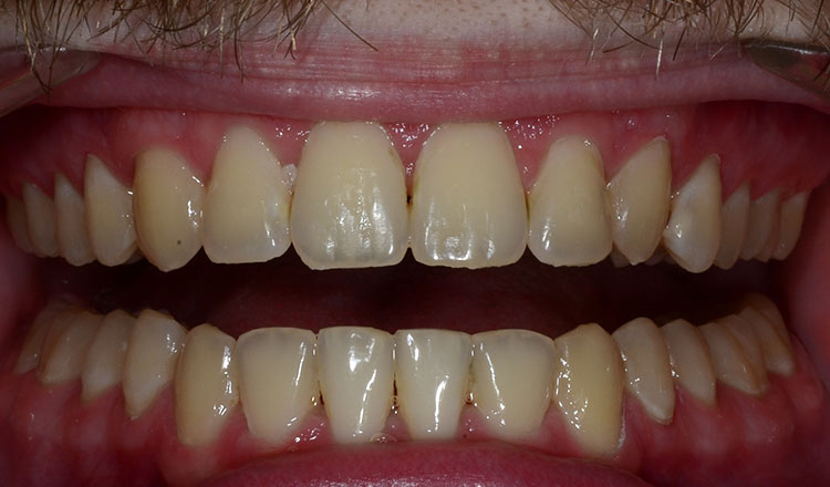 Combo TX orthodontic treatment after - patient 6