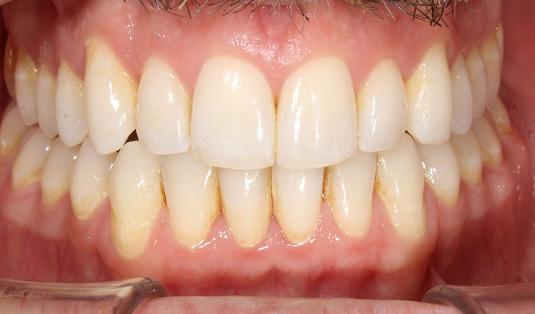 Crossbite orthodontic treatment after - patient 6
