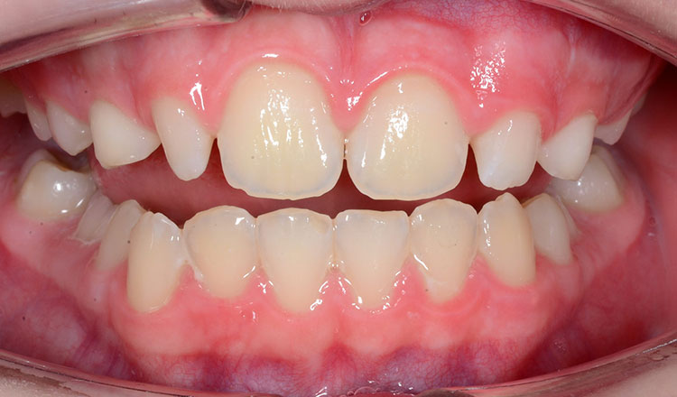 Crowding orthodontic treatment after - patient 6