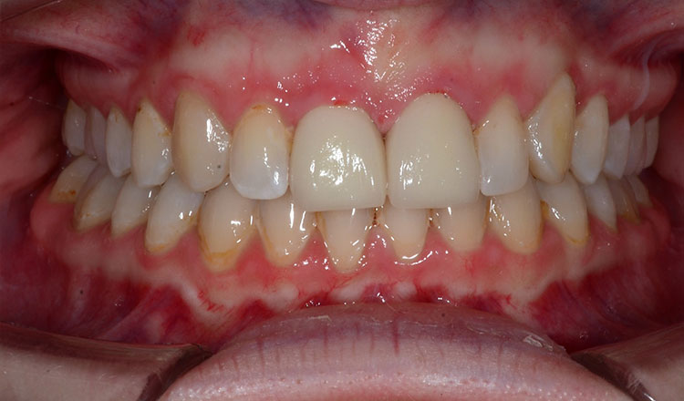 Impacted Canines orthodontic treatment after - patient 6