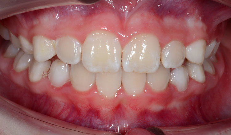 Phase I orthodontic treatment after - patient 6