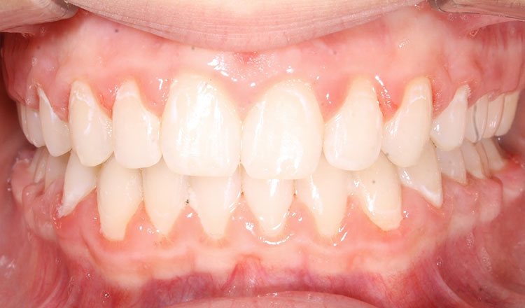 Class II orthodontic treatment after - patient 6