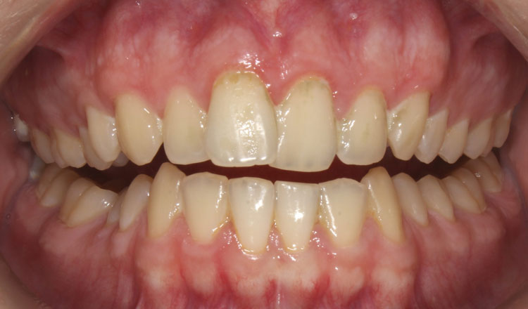 Combo TX orthodontic treatment before - patient 6