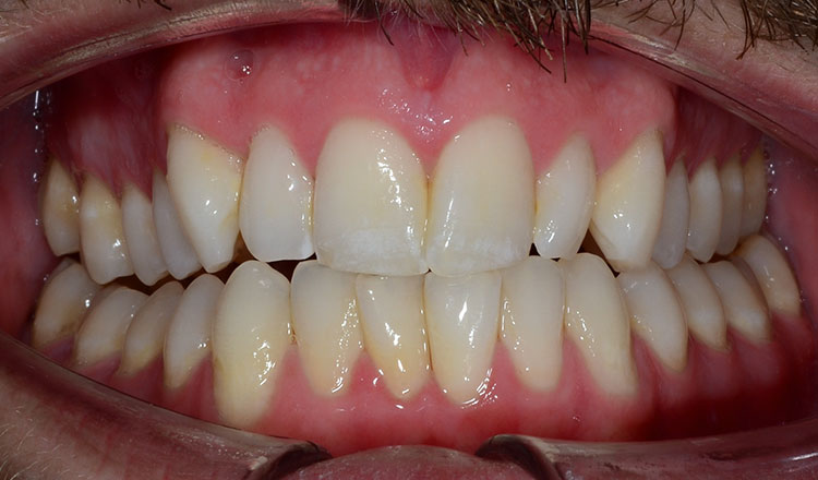 Crossbite orthodontic treatment before - patient 6
