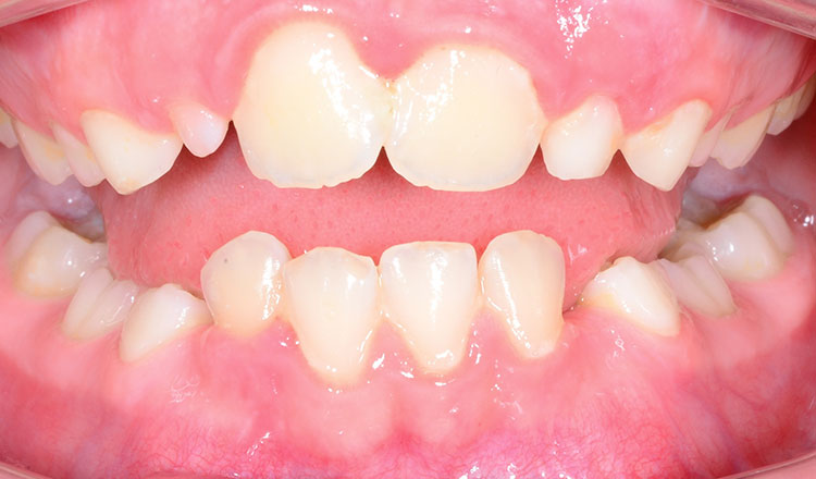 Crowding orthodontic treatment before - patient 6