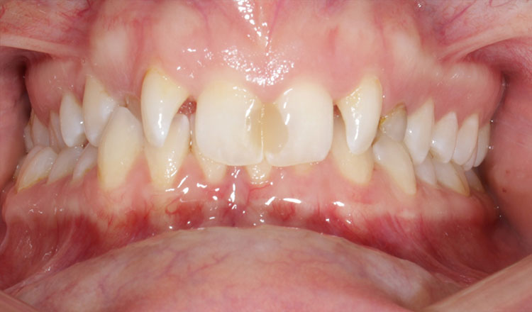 Impacted Canines orthodontic treatment before - patient 6