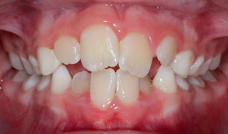 Phase I orthodontic treatment before - patient 6