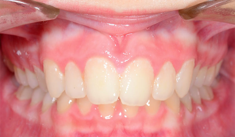 Class II orthodontic treatment before - patient 6