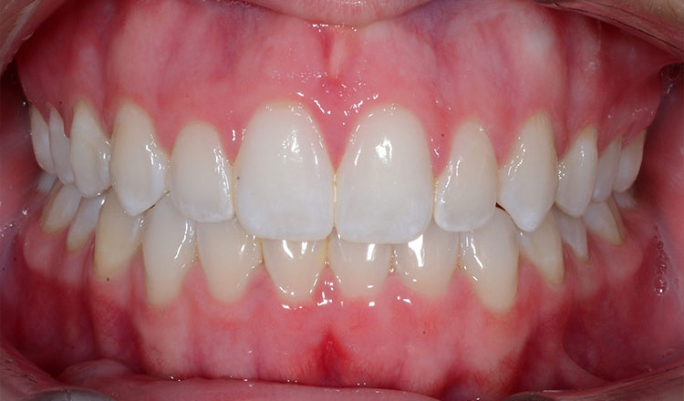 Combo TX orthodontic treatment after - patient 7