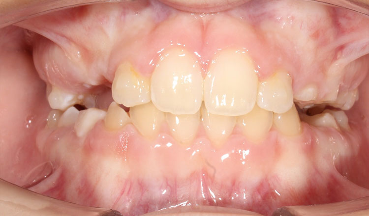 Crossbite orthodontic treatment after - patient 7