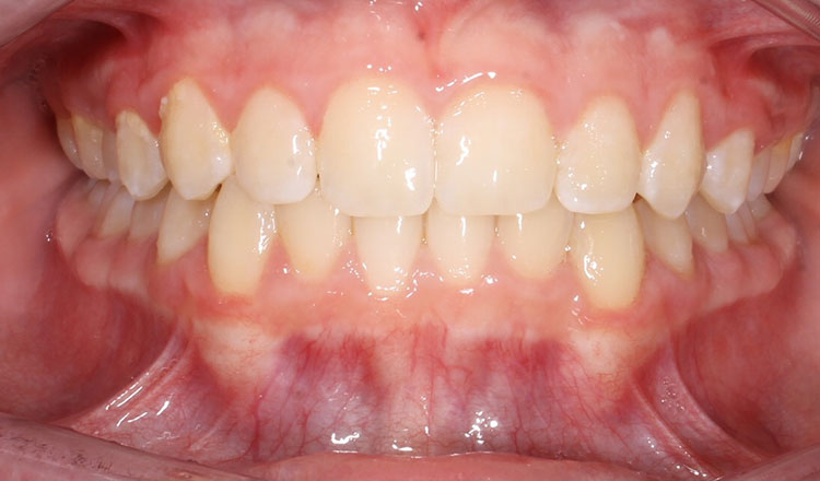 Crowding orthodontic treatment after - patient 7