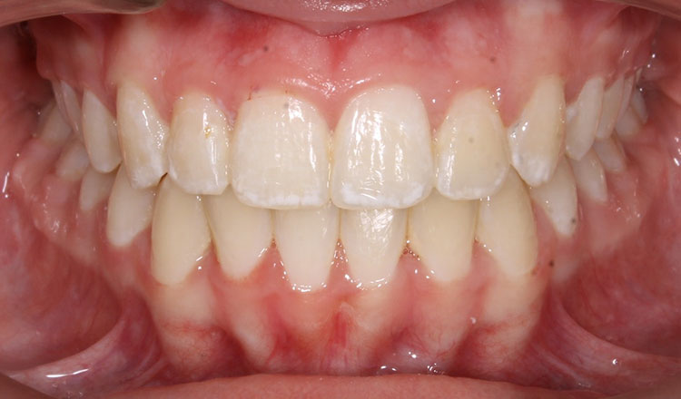 Impacted Canines orthodontic treatment after - patient 7